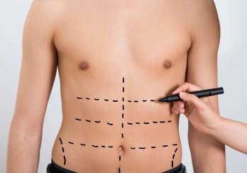 Liposuction (Yağ Alma)