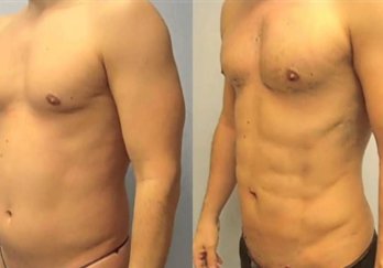 Vaser Liposuction