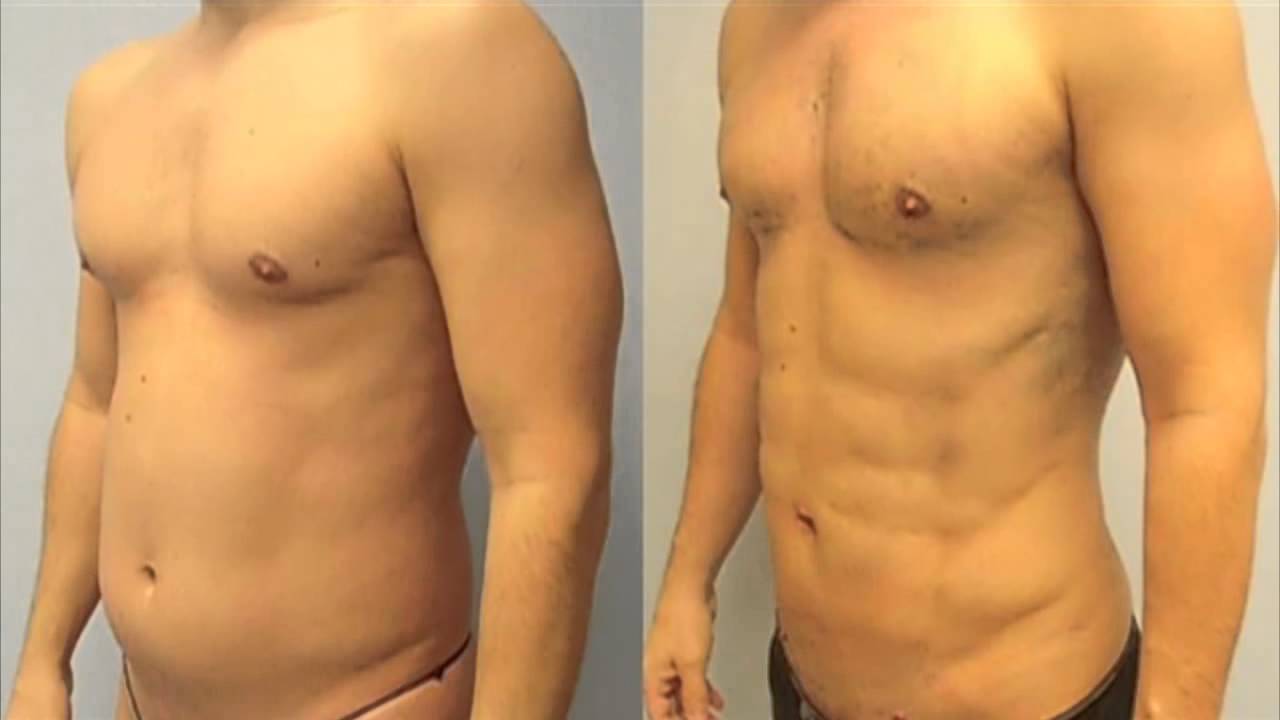 Vaser Liposuction